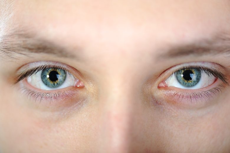 A conjuntivite acontece na membrana que envolve a parte branca dos olhos
